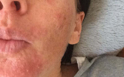 Perioale Dermatitis